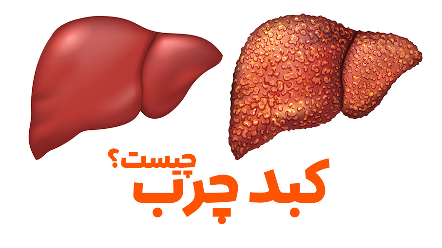 کبد چرب چیست؟